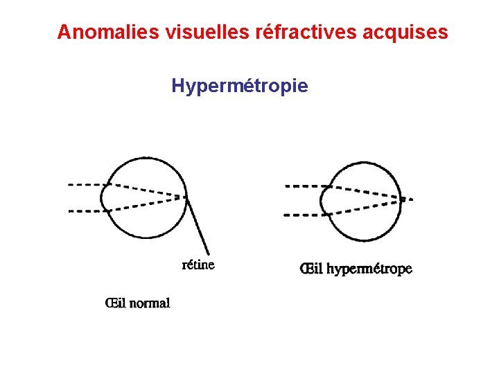 Anomalies visuelles réfractives acquises Hypermétropie Anomalies visuelles réfractives acquises Hypermétropie