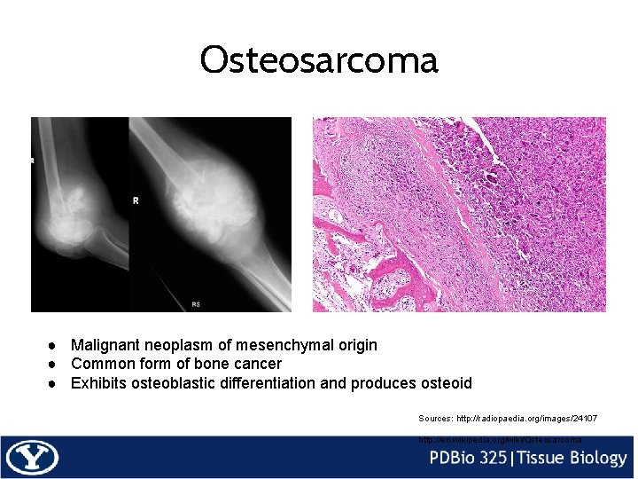 Osteosarcoma ● Malignant neoplasm of mesenchymal origin ● Common form of bone cancer ●