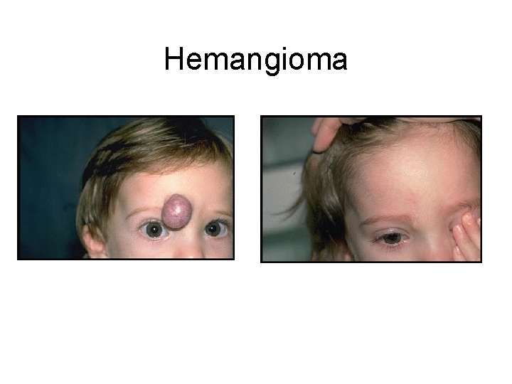 Hemangioma 