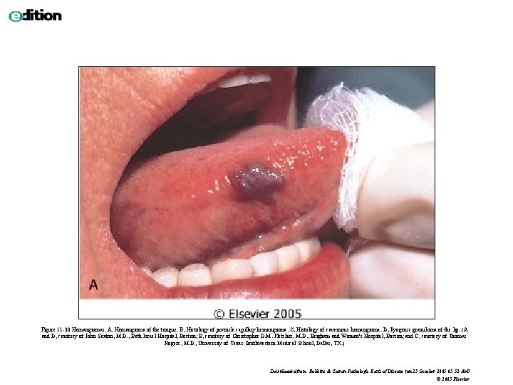 Figure 11 -30 Hemangiomas. A, Hemangioma of the tongue. B, Histology of juvenile capillary