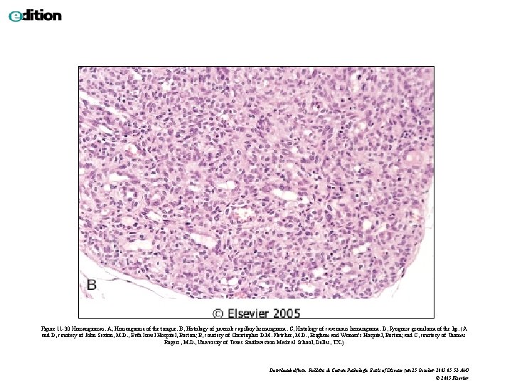 Figure 11 -30 Hemangiomas. A, Hemangioma of the tongue. B, Histology of juvenile capillary