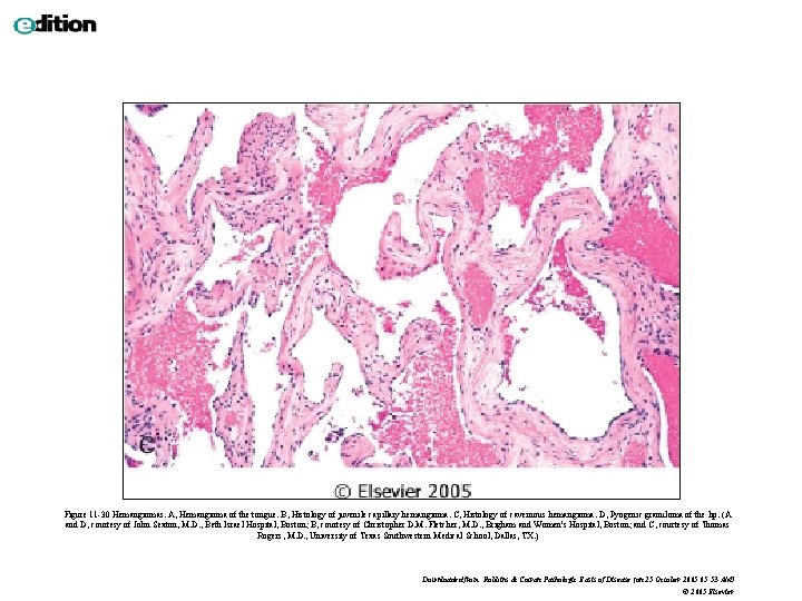 Figure 11 -30 Hemangiomas. A, Hemangioma of the tongue. B, Histology of juvenile capillary