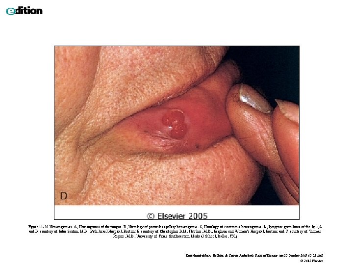 Figure 11 -30 Hemangiomas. A, Hemangioma of the tongue. B, Histology of juvenile capillary