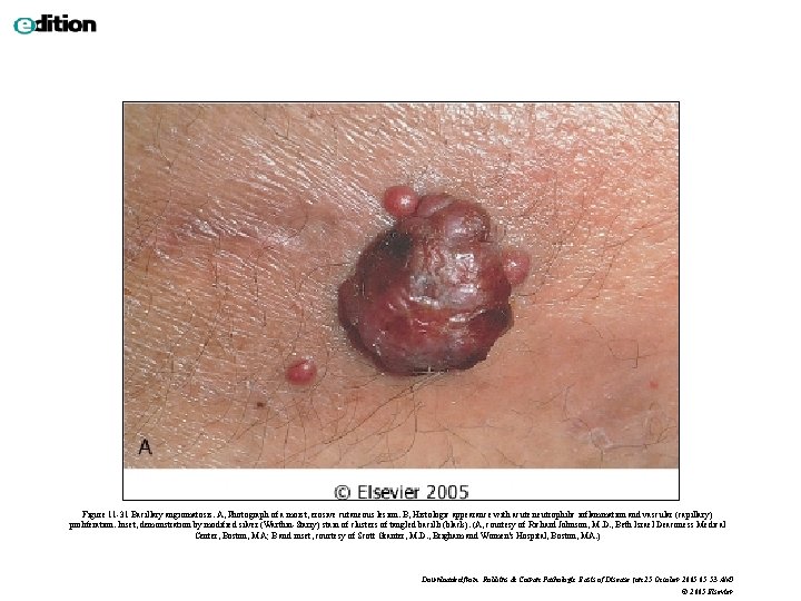 Figure 11 -31 Bacillary angiomatosis. A, Photograph of a moist, erosive cutaneous lesion. B,