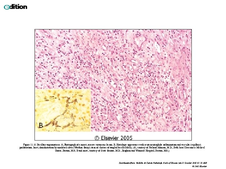 Figure 11 -31 Bacillary angiomatosis. A, Photograph of a moist, erosive cutaneous lesion. B,