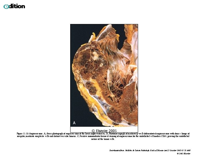 Figure 11 -33 Angiosarcoma. A, Gross photograph of angiosarcoma of the heart (right ventricle).