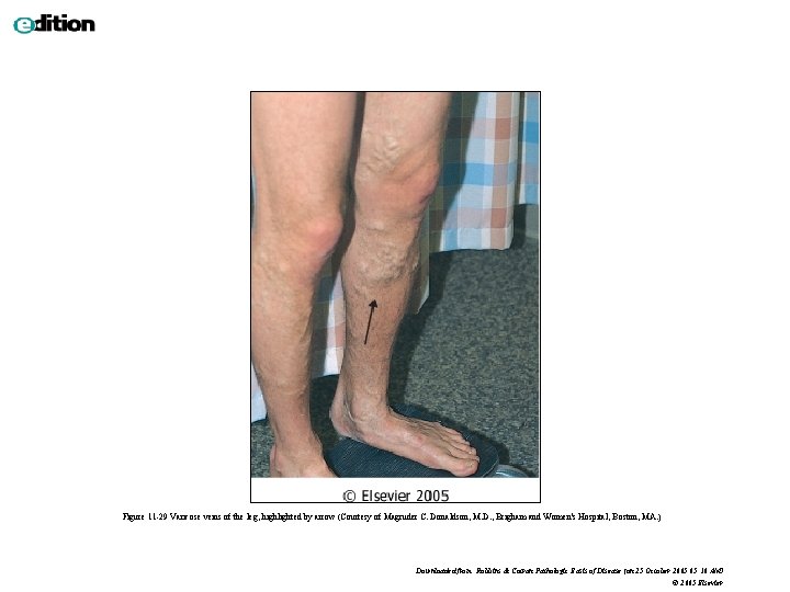 Figure 11 -29 Varicose veins of the leg, highlighted by arrow (Courtesy of Magruder