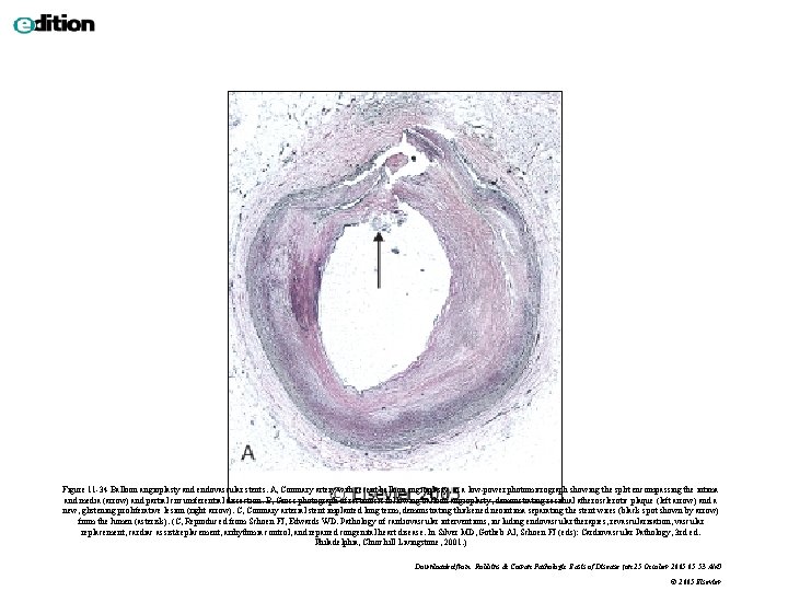Figure 11 -34 Balloon angioplasty and endovascular stents. A, Coronary artery with recent balloon