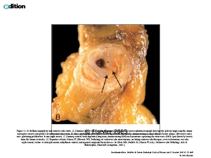 Figure 11 -34 Balloon angioplasty and endovascular stents. A, Coronary artery with recent balloon