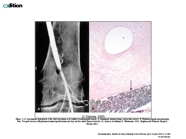 Figure 11 -35 Anastomotic hyperplasia at the distal anastomosis of synthetic femoropopliteal graft. A,