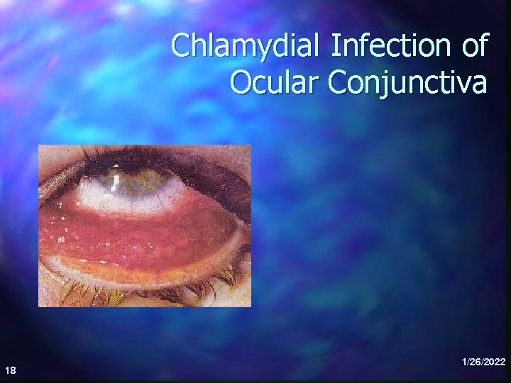 Chlamydial Infection of Ocular Conjunctiva 18 1/26/2022 