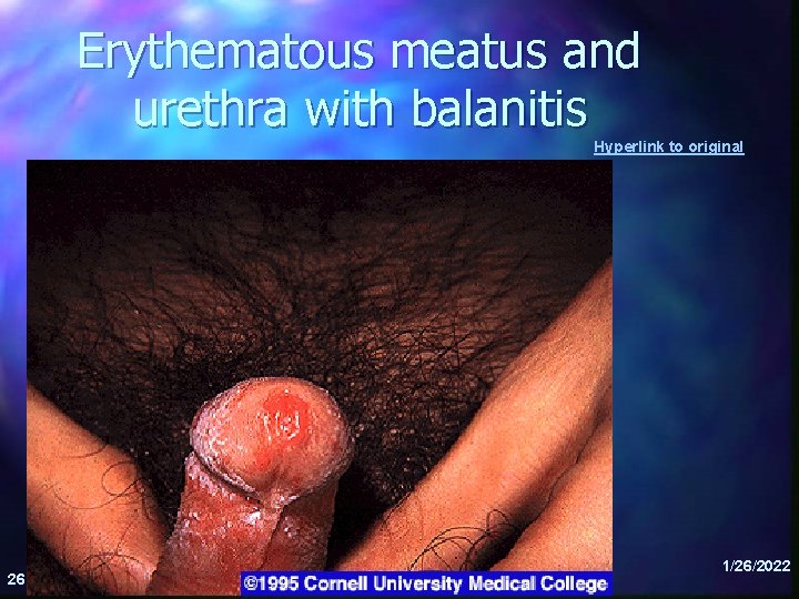 Erythematous meatus and urethra with balanitis Hyperlink to original 26 1/26/2022 
