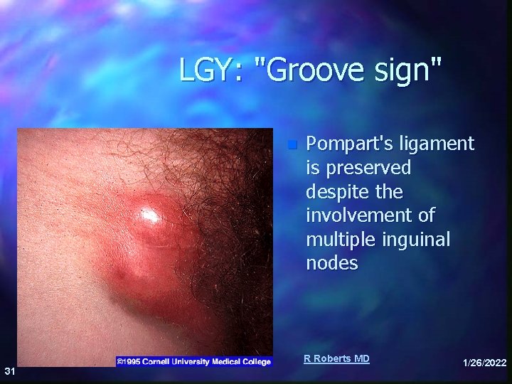 LGY: "Groove sign" n Pompart's ligament is preserved despite the involvement of multiple inguinal