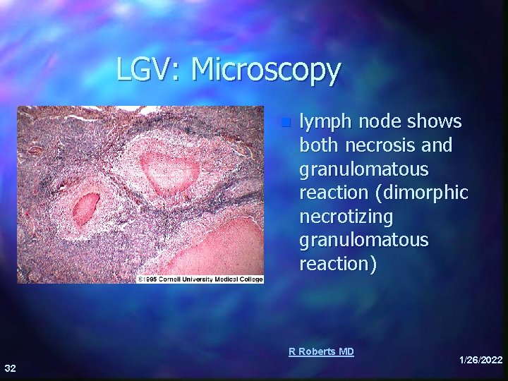 LGV: Microscopy n lymph node shows both necrosis and granulomatous reaction (dimorphic necrotizing granulomatous