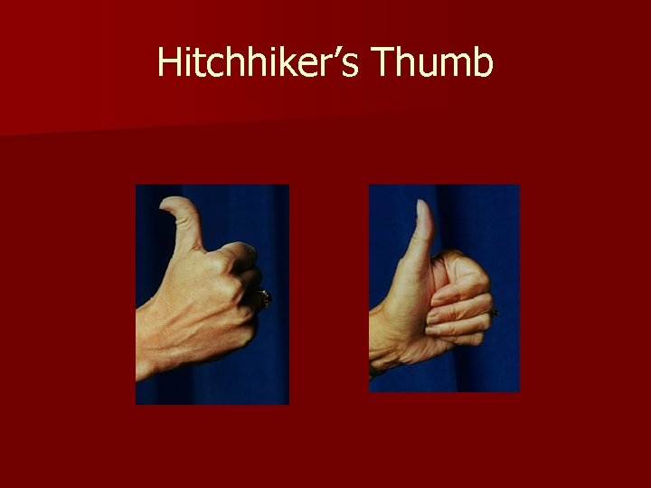 Hitchhiker’s Thumb 