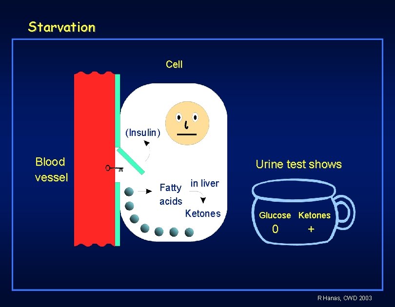 Starvation Cell (Insulin) Blood vessel Urine test shows Fatty in liver acids Ketones Glucose