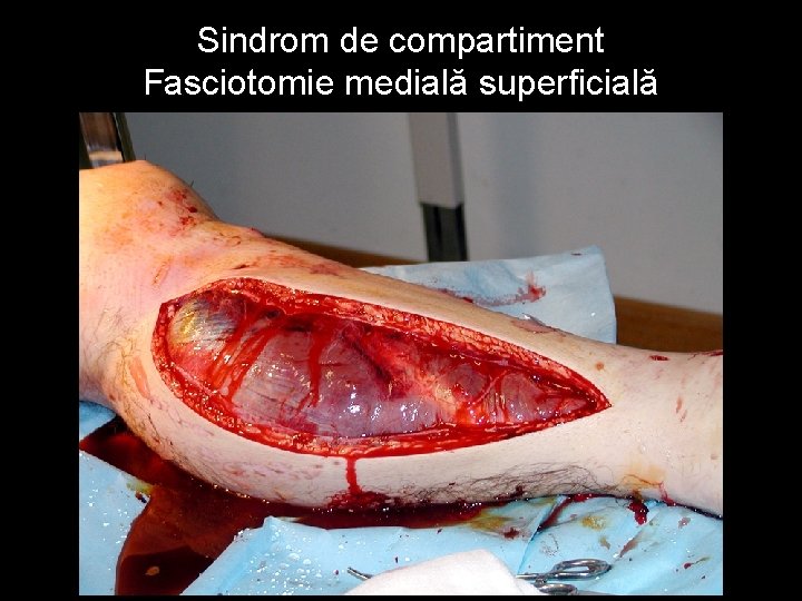 Sindrom de compartiment Fasciotomie medială superficială 