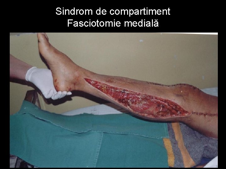 Sindrom de compartiment Fasciotomie medială 