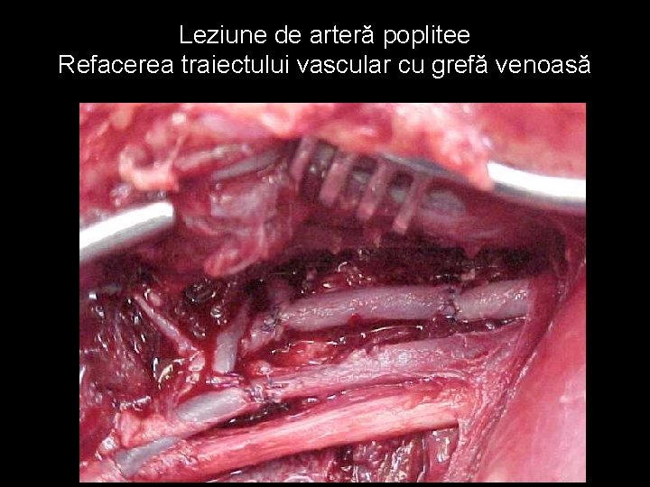 Leziune de arteră poplitee Refacerea traiectului vascular cu grefă venoasă 