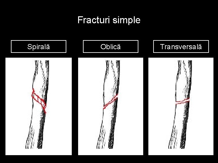 Fracturi simple Spirală Oblică Transversală 