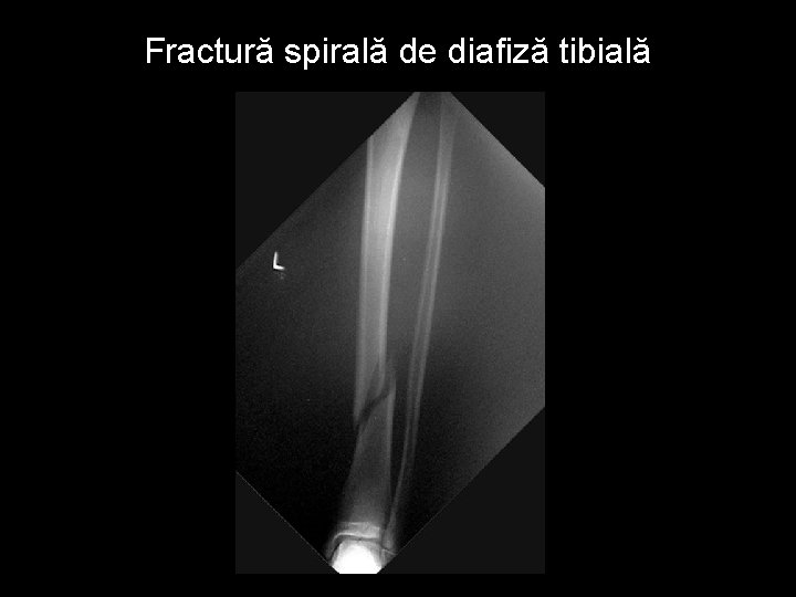 Fractură spirală de diafiză tibială 