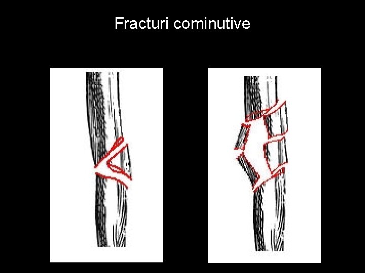 Fracturi cominutive 