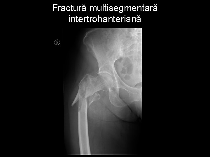 Fractură multisegmentară intertrohanteriană 