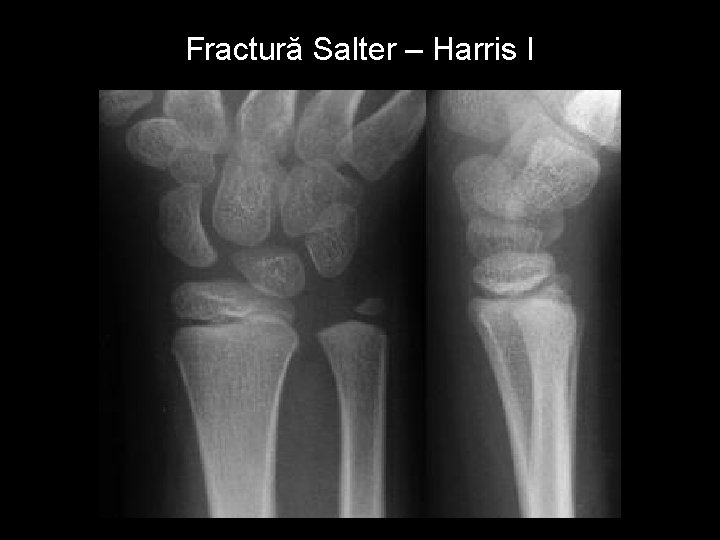 Fractură Salter – Harris I 