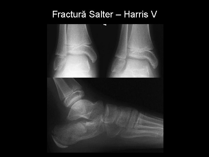 Fractură Salter – Harris V 