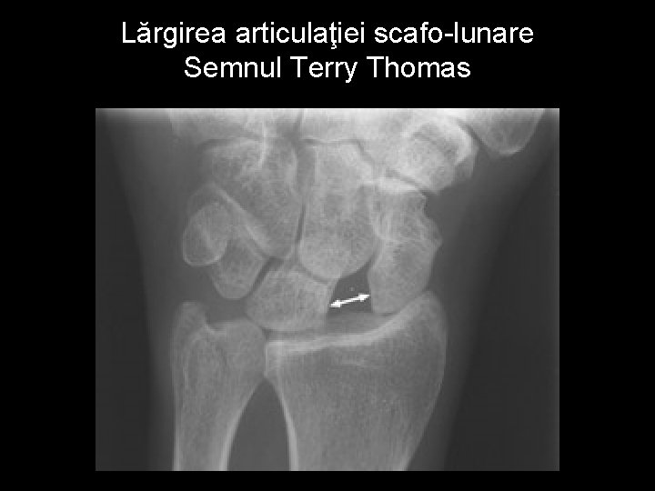 Lărgirea articulaţiei scafo-lunare Semnul Terry Thomas 
