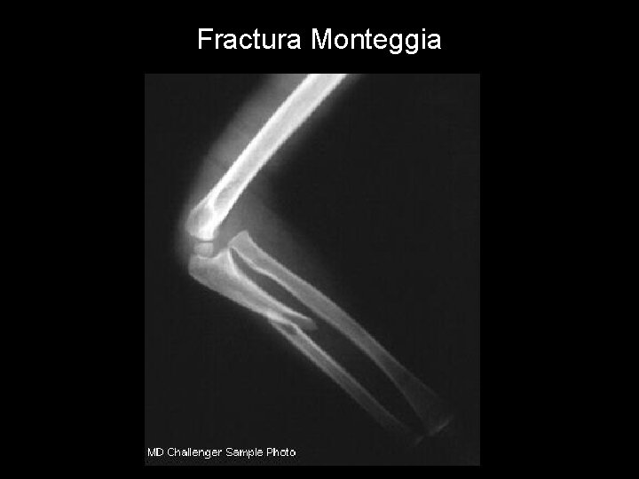 Fractura Monteggia 