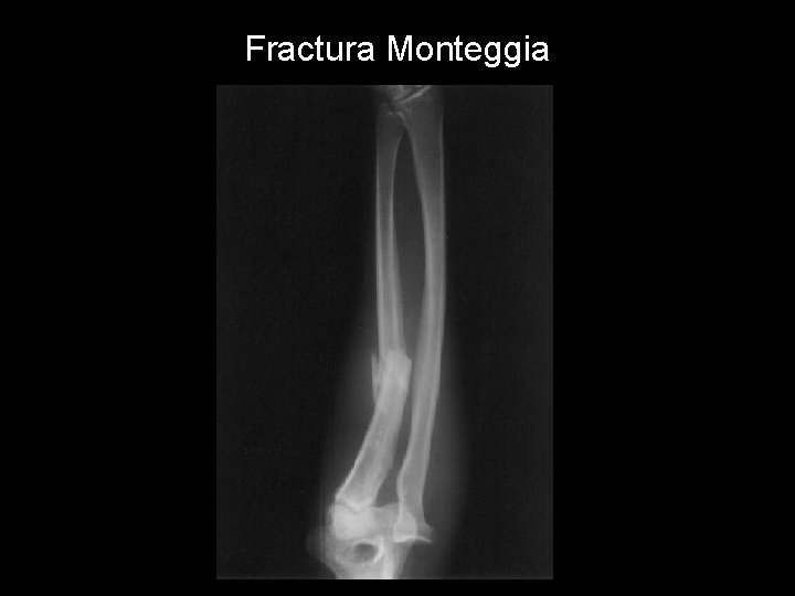 Fractura Monteggia 