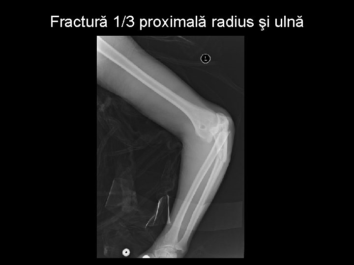 Fractură 1/3 proximală radius şi ulnă 