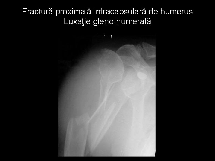 Fractură proximală intracapsulară de humerus Luxaţie gleno-humerală 