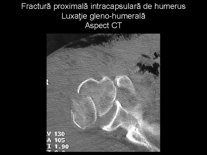 Fractură proximală intracapsulară de humerus Luxaţie gleno-humerală Aspect CT 