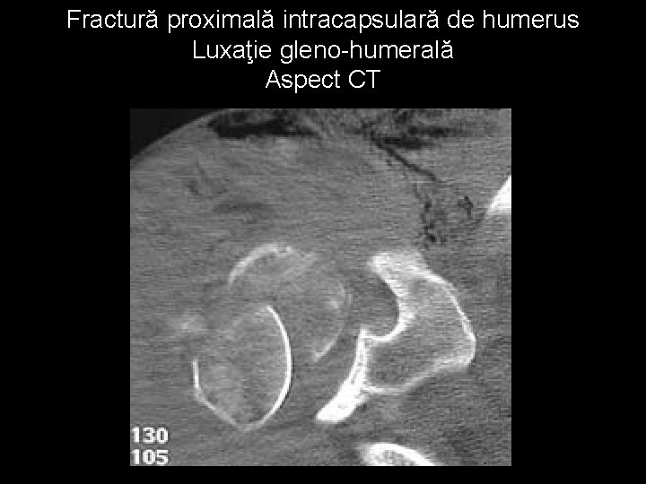 Fractură proximală intracapsulară de humerus Luxaţie gleno-humerală Aspect CT 