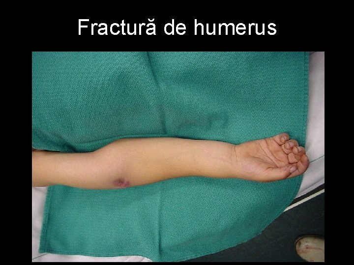 Fractură de humerus 