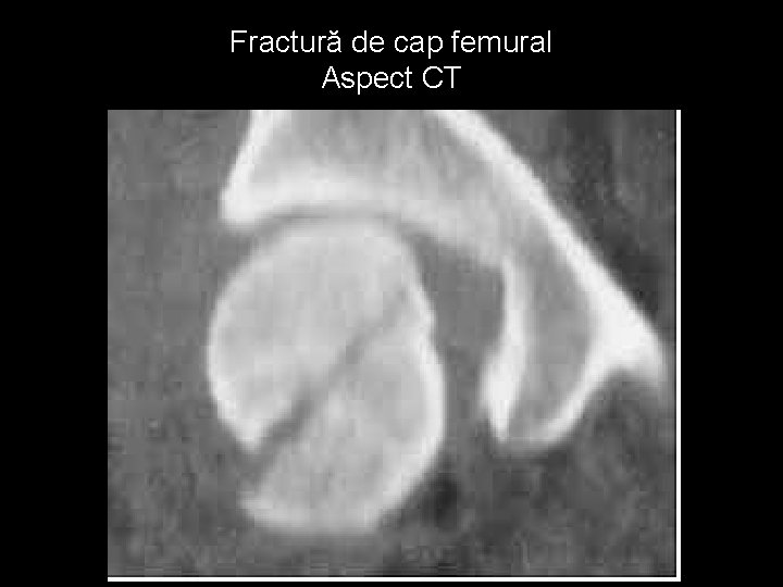 Fractură de cap femural Aspect CT 