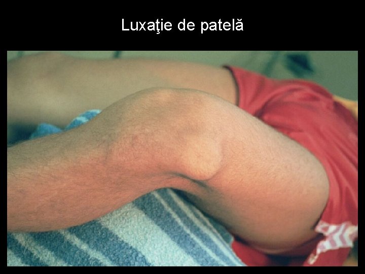 Luxaţie de patelă 