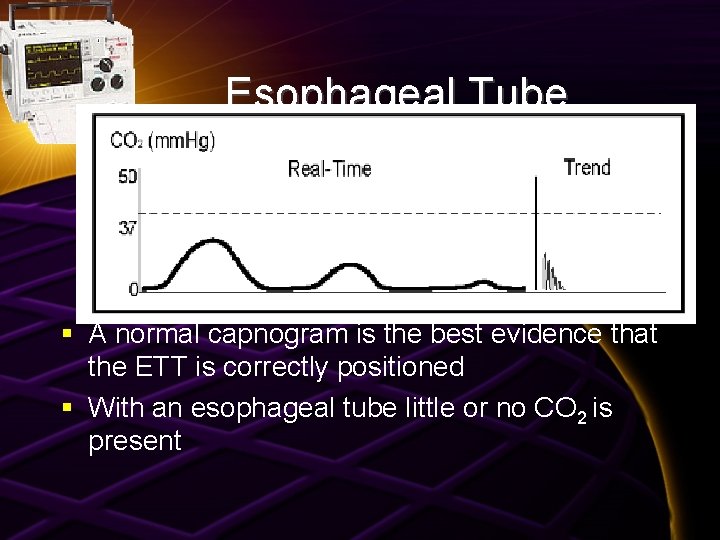Esophageal Tube § A normal capnogram is the best evidence that the ETT is
