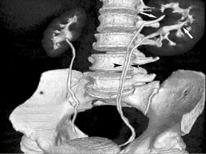 Duplication of the ureter 