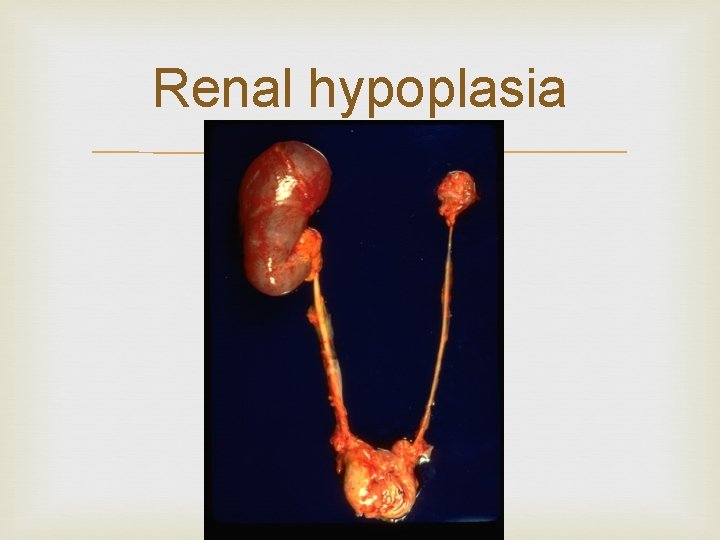 Renal hypoplasia 