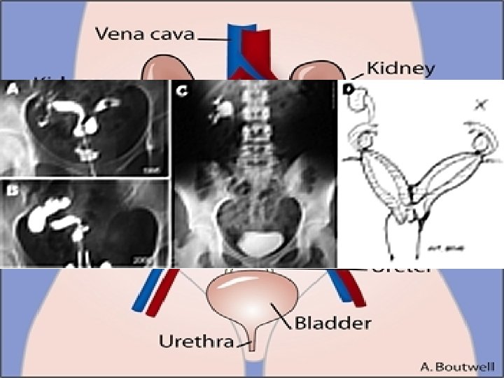 Renal fusion (horseshoe kidney) 