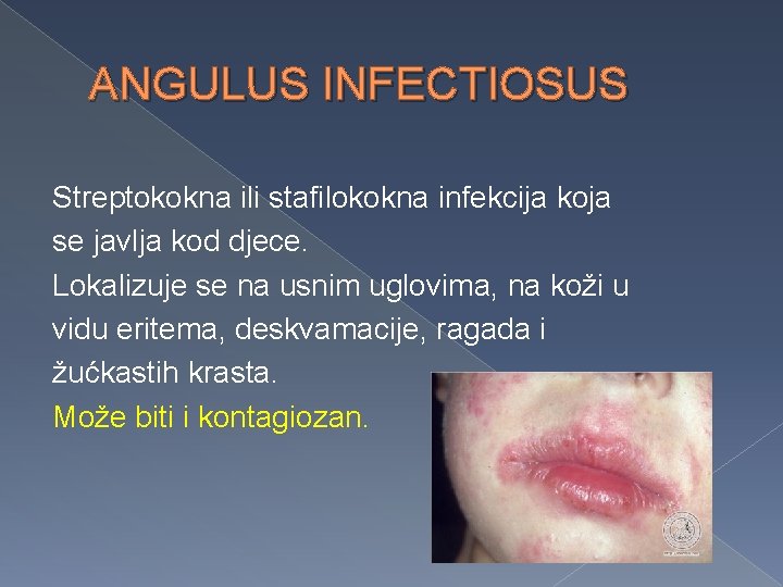 ANGULUS INFECTIOSUS Streptokokna ili stafilokokna infekcija koja se javlja kod djece. Lokalizuje se na