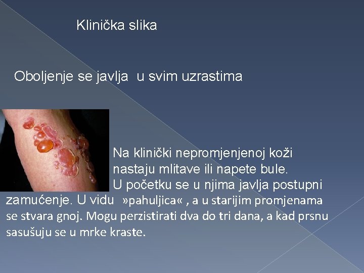 Klinička slika Oboljenje se javlja u svim uzrastima Na klinički nepromjenjenoj koži nastaju mlitave