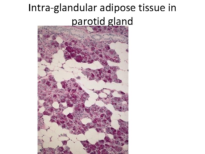 Intra-glandular adipose tissue in parotid gland 