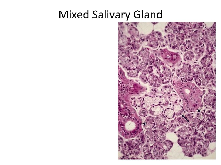 Mixed Salivary Gland 