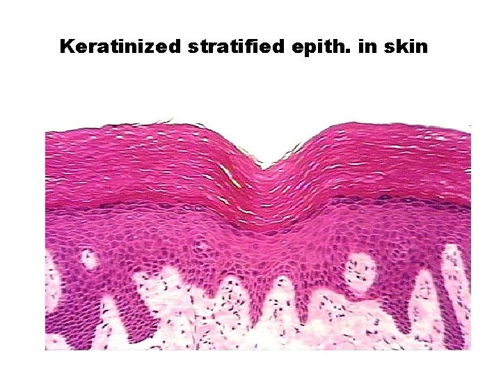 Keratinized stratified epith. in skin 