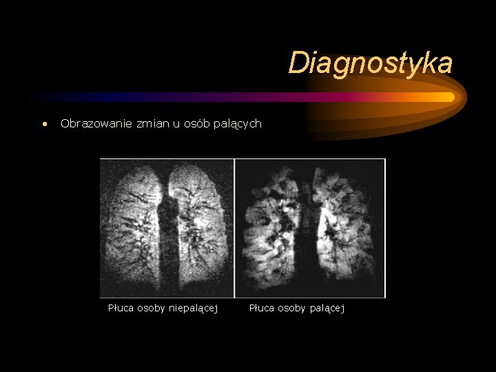 Diagnostyka • Obrazowanie zmian u osób palących Płuca osoby niepalącej Płuca osoby palącej 