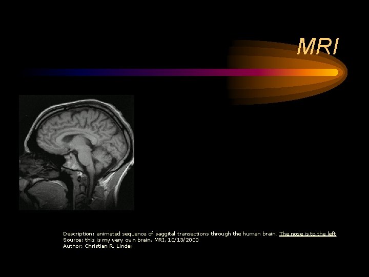 MRI Description: animated sequence of saggital transections through the human brain. The nose is